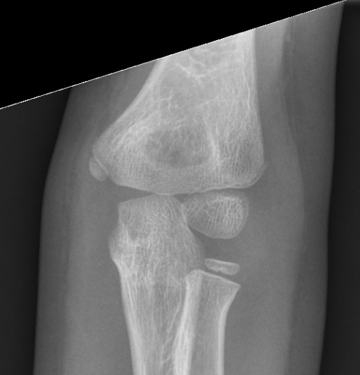 Lateral Condyle Paeds Undisplaced